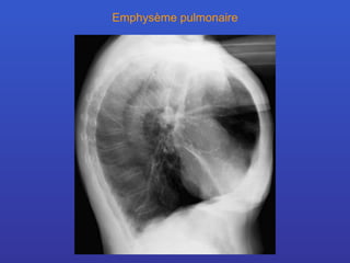 Emphysème pulmonaire 
