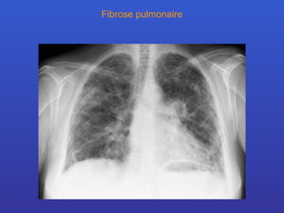 Fibrose pulmonaire 