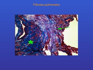 Fibrose pulmonaire 