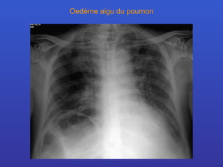 Oedème aigu du poumon 