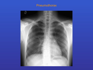 Pneumothorax 