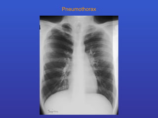 Pneumothorax 