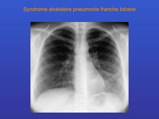 Syndrome alvéolaire pneumonie franche lobaire 