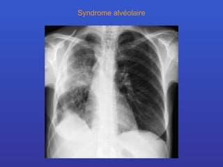 Syndrome alvéolaire 
