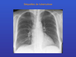 Séquelles de tuberculose 