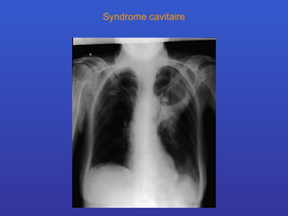 Syndrome cavitaire 