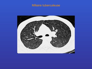 Miliaire tuberculeuse 
