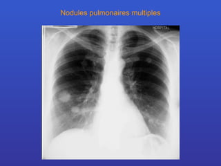 Nodules pulmonaires multiples 
