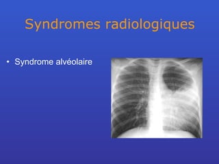 Syndromes radiologiques Syndrome alvéolaire 