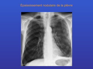 Épaississement nodulaire de la plèvre 