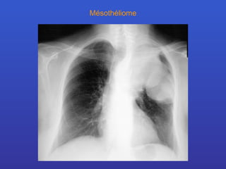 Mésothéliome 
