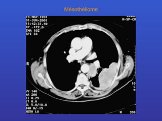 Mésothéliome 