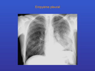 Empyème pleural 