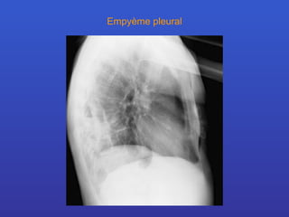Empyème pleural 