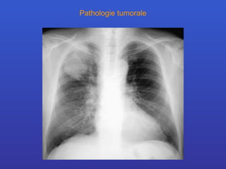 Pathologie tumorale 