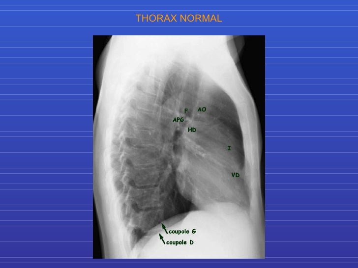 Rx Thorax