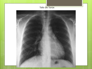 Torax Ex Rx torax | PPTX