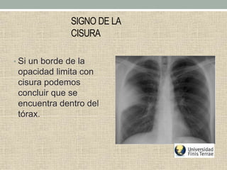 SIGNO DE LA
CISURA
• Si un borde de la
opacidad limita con
cisura podemos
concluir que se
encuentra dentro del
tórax.
 