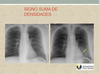 SIGNO SUMA DE
DENSIDADES
 