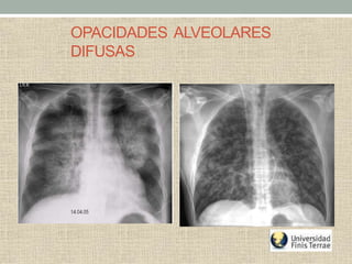 OPACIDADES ALVEOLARES
DIFUSAS
 