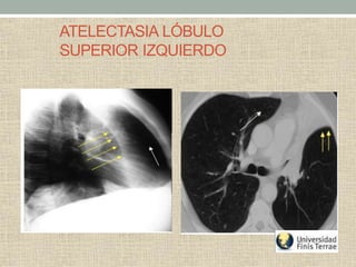 ATELECTASIA LÓBULO
SUPERIOR IZQUIERDO
 