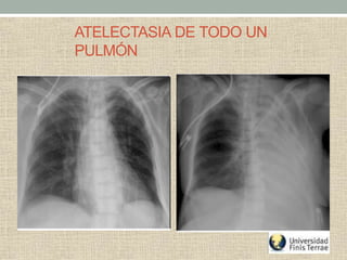 ATELECTASIA DE TODO UN
PULMÓN
 