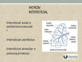 PATRÓN
INTERSTICIAL
- Intersticial axial o
peribroncovascula
r
- Intersticial periférico
- Intersticial alveolar o
parenquimatoso
 