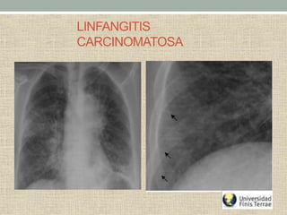 LINFANGITIS
CARCINOMATOSA
 