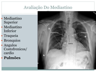 Avaliação Do Mediastino
 Mediastino
Superior
 Mediastino
Inferior
 Traqueia
 Bronquios
 Angulos
Costofrenicos/
cardio
 Pulmões
 