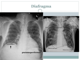 Diafragma
pneumoperitoneo
 
