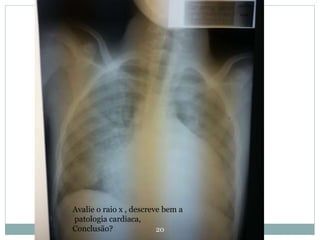 20
Avalie o raio x , descreve bem a
patologia cardiaca,
Conclusão?
 