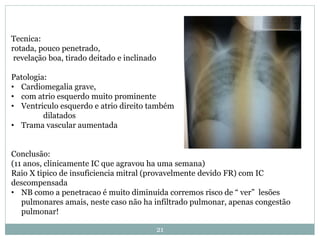 21
Tecnica:
rotada, pouco penetrado,
revelação boa, tirado deitado e inclinado
Patologia:
• Cardiomegalia grave,
• com atrio esquerdo muito prominente
• Ventriculo esquerdo e atrio direito também
dilatados
• Trama vascular aumentada
Conclusão:
(11 anos, clinicamente IC que agravou ha uma semana)
Raio X tipico de insuficiencia mitral (provavelmente devido FR) com IC
descompensada
• NB como a penetracao é muito diminuida corremos risco de “ ver” lesões
pulmonares amais, neste caso não ha infiltrado pulmonar, apenas congestão
pulmonar!
 