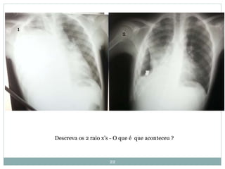 22
Descreva os 2 raio x’s - O que é que aconteceu ?
1
2
 