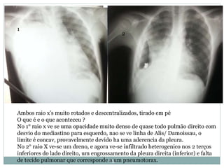 23
Ambos raio x’s muito rotados e descentralizados, tirado em pé
O que é e o que aconteceu ?
No 1° raio x ve se uma opacidade muito denso de quase todo pulmão direito com
desvio do mediastino para esquerdo, nao se ve linha de Alis/ Damoissau, o
limite é concav, provavelmente devido ha uma aderencia da pleura.
No 2° raio X ve-se um dreno, e agora ve-se infiltrado heterogenico nos 2 terços
inferiores do lado direito, um engrossamento da pleura direita (inferior) e falta
de tecido pulmonar que corresponde a um pneumotorax.
1
2
 