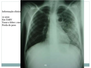 25
Informação clinica:
12 anos
Em TARV
Tosse e febre 1 mes
Perda de peso
 
