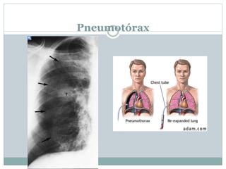 Pneumotórax
 
