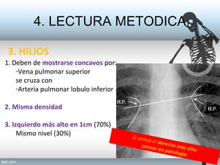 4. LECTURA METODICA
3. HILIOS
1. Deben de mostrarse concavos por:
-Vena pulmonar superior
se cruza con
-Arteria pulmonar l...