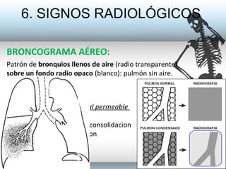 6. SIGNOS RADIOLÓGICOS
BRONCOGRAMA AÉREO:
Patrón de bronquios llenos de aire (radio transparente)
sobre un fondo radio opa...