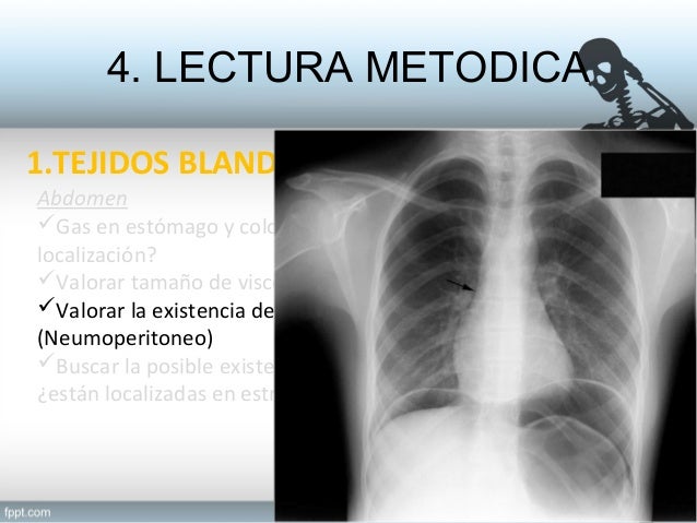 Radiograf a abdominal
