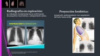Radiografía en espiración:
su indicación fundamental es la confirmación
de pequeños neumotórax y atrapamiento aéreo.
Proyección lordótica:
proyección anteroposterior con angulación
del tubo hacia arriba
Guía practica para radiología de tórax en atención primaria, Dr.
Carlos M.M. Ed. Adalia. Peru. 2005
 