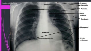 Radiología de Tórax
 
