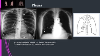 Pleura
4) cisura interlobar menor. 6) Pleura paracardiaca.
7) cayado de la aorta. 8) ventana aortopulmonar.
 