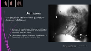 En la proyección lateral debemos guiarnos por
dos signos radiológicos:
Diafragma
 La cámara de aire gástrica por debajo del hemidiafragma
izquierdo y al entrar en contacto con el corazón pierde su
continuidad (signo de la silueta).
 hemidiafragma derecho sobrepasa la silueta cardiaca y
hace contacto con la porción anterior del tórax
Guía practica para radiología de tórax en atención primaria, Dr.
Carlos M.M. Ed. Adalia. Peru. 2005
 