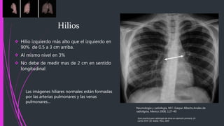  Hilio izquierdo más alto que el izquierdo en
90% de 0.5 a 3 cm arriba.
 Al mismo nivel en 3%
 No debe de medir mas de 2 cm en sentido
longitudinal
Neumología y radiología, M.C. Gaspar Alberto,Anales de
radiolgoia, Mexico 2008; 1:27-40
Las imágenes hiliares normales están formadas
por las arterias pulmonares y las venas
pulmonares…
Hilios
Guía practica para radiología de tórax en atención primaria, Dr.
Carlos M.M. Ed. Adalia. Peru. 2005
 