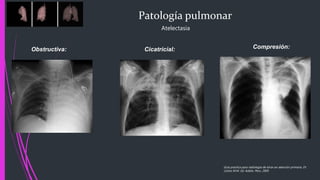 Patología pulmonar
Obstructiva:
Atelectasia
Cicatricial: Compresión:
Guía practica para radiología de tórax en atención primaria, Dr.
Carlos M.M. Ed. Adalia. Peru. 2005
 