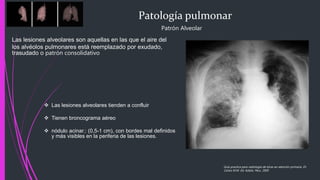 Patología pulmonar
Patrón Alveolar
Las lesiones alveolares son aquellas en las que el aire del
los alvéolos pulmonares está reemplazado por exudado,
trasudado o patrón consolidativo
 Las lesiones alveolares tienden a confluir
 Tienen broncograma aéreo
 nódulo acinar.: (0,5-1 cm), con bordes mal definidos
y más visibles en la periferia de las lesiones.
Guía practica para radiología de tórax en atención primaria, Dr.
Carlos M.M. Ed. Adalia. Peru. 2005
 