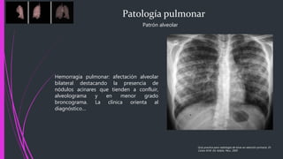 Patología pulmonar
Patrón alveolar
Guía practica para radiología de tórax en atención primaria, Dr.
Carlos M.M. Ed. Adalia. Peru. 2005
Hemorragia pulmonar: afectación alveolar
bilateral destacando la presencia de
nódulos acinares que tienden a confluir,
alveolograma y en menor grado
broncograma. La clínica orienta al
diagnóstico…
 