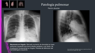 Patología pulmonar
Patrón alveolar
Neumonía en língula. Marcado aumento de densidad en base
pulmonar izquierda que borra silueta cardiaca y, por tanto, de
localización fundamental en língula. Pérdida de definición del
hemidiafragma izquierdo.
Guía practica para radiología de tórax en atención primaria, Dr.
Carlos M.M. Ed. Adalia. Peru. 2005
 
