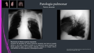Patología pulmonar
Patrón alveolar
Neumonía en lóbulo superior izquierdo:
aumento de densidad en vértice pulmonar izquierdo que borra el cayado
aórtico y, por tanto, localiza la lesión en el segmento apical posterior del
lóbulo superior (signo de la silueta). Además, muestra un margen inferior
mal definido con broncograma y alveolograma aéreo.
Guía practica para radiología de tórax en atención primaria, Dr.
Carlos M.M. Ed. Adalia. Peru. 2005
 