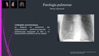 Patología pulmonar
Patrón intersticial
Guía practica para radiología de tórax en atención primaria, Dr.
Carlos M.M. Ed. Adalia. Peru. 2005
Linfangitis carcinomatosa:
se observa un predomino del
engrosamiento peribroncovascular y
peribronquial adyacente al hilio y un
engrosamiento periférico de los septos.
 